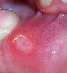 Illustration for article titled Mediclopnik: What is this sore on the inside of my lip?